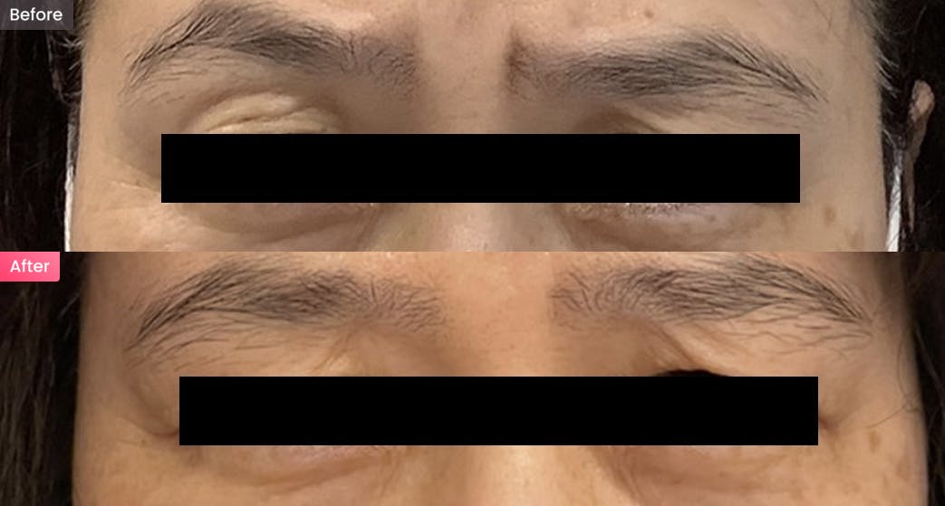【しわ】眉間のしわが気になるの写真