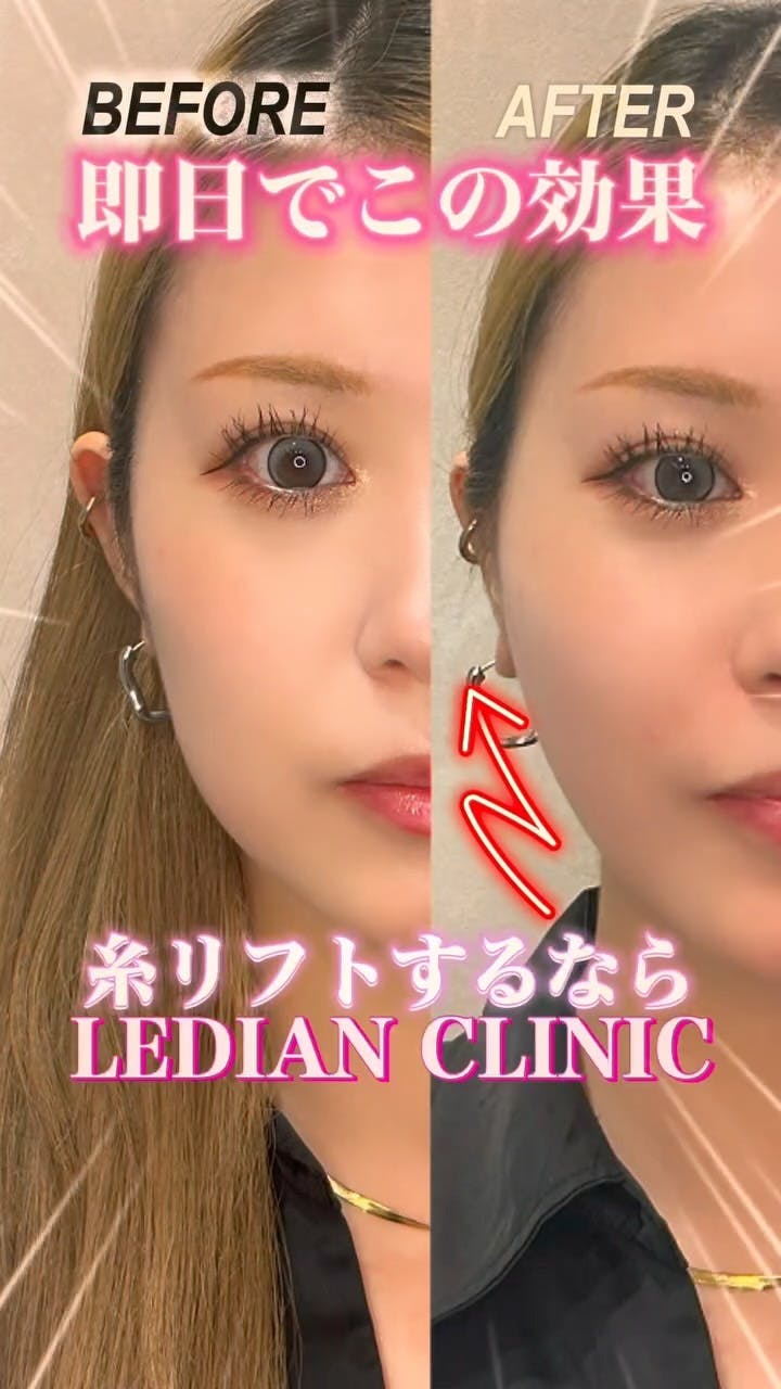 【女性・たるみ】糸リフト_before_aftar