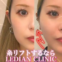 【女性・たるみ】糸リフト_before_aftar