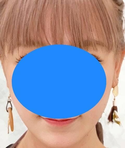 プリズムビューティークリニック(PRISM Beauty Clinic)で糸リフト(スレッドリフト)を受けた吹雪丸さんの写真