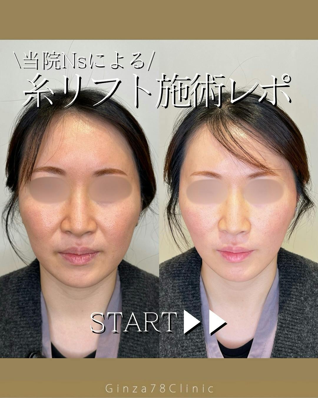 糸リフト(スレッドリフト)の症例写真・ビフォーアフター画像No