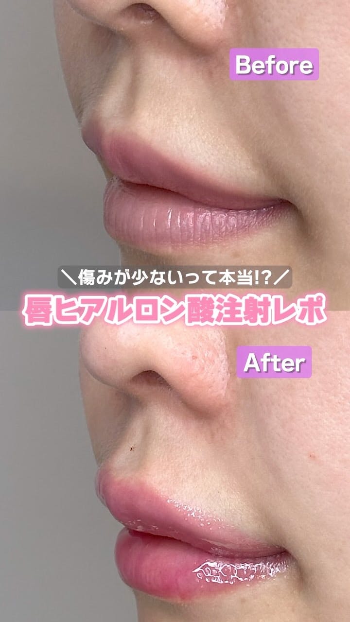 【女性・唇】ヒアルロン酸（唇）_before_aftar