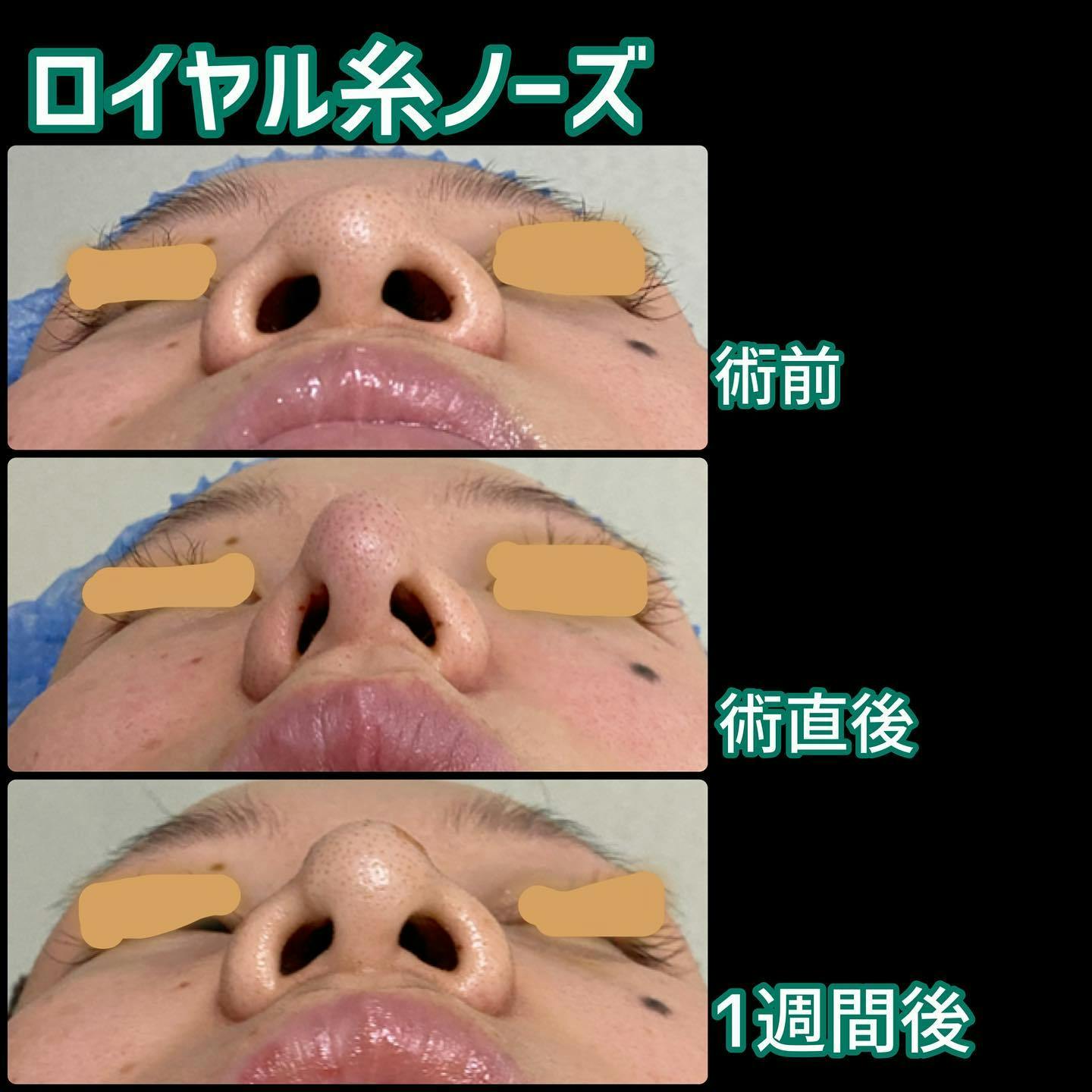 【女性・鼻】ロイヤル糸ノーズ_before_aftar
