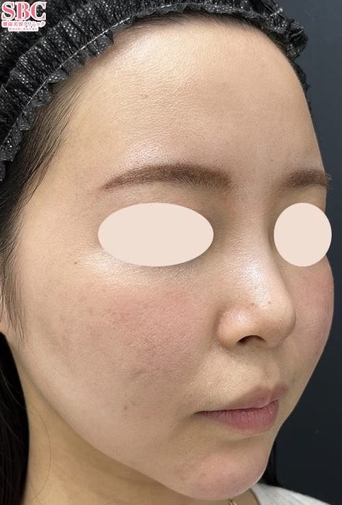 【女性・顎】ヒアルロン酸_after