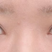 【女性・目元】線留めクロス二重術 自然癒着セット(上眼瞼脱脂)_after