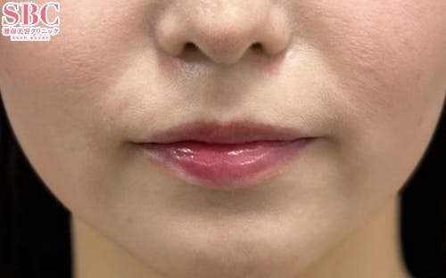 【女性・口角】口角挙上_after