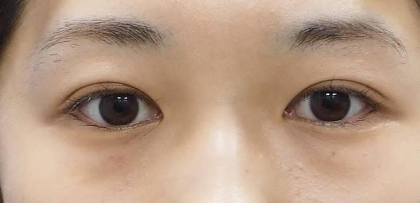 湘南美容クリニック 渋谷院で切る二重術（切開法）：全切開法二重術を受けたルイさんの写真