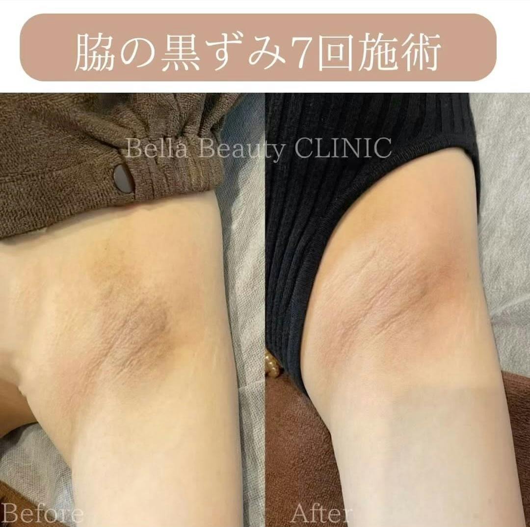 【女性・黒ずみ】ミラノリピール＋ピコトーニング_before_aftar