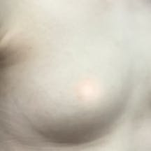 【女性・胸】Motivaエルゴノミックス2(バッグ豊胸)_before