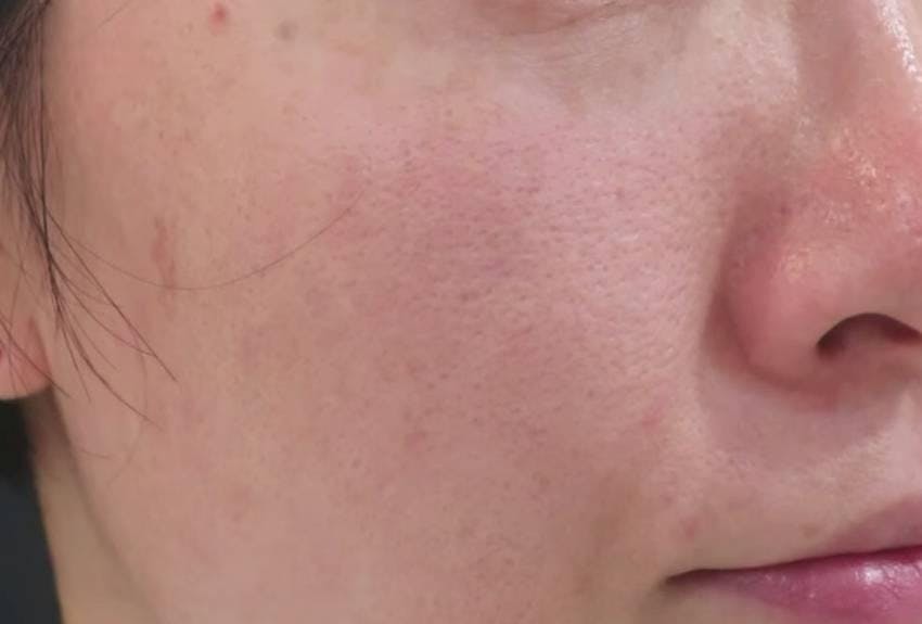 品川スキンクリニック 品川本院でコラーゲンピール+顔フォトシルクプラス+水玉スキン：コラーゲンピール+顔フォトシルクプラス+水玉スキンを受けたゆりさんの写真