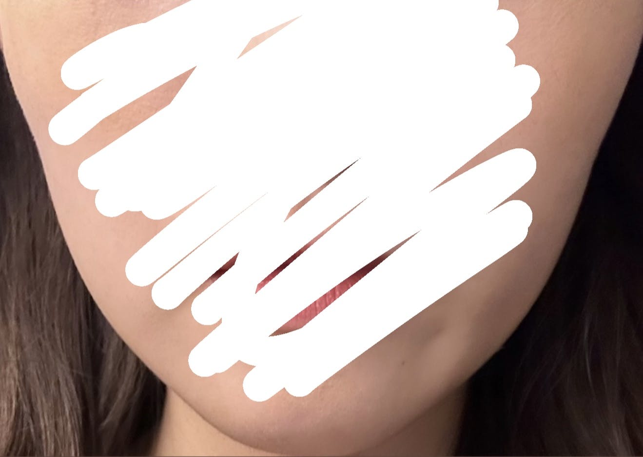 湘南美容クリニック  名古屋院でエラボトックス注射(小顔)を受けたaさんの写真