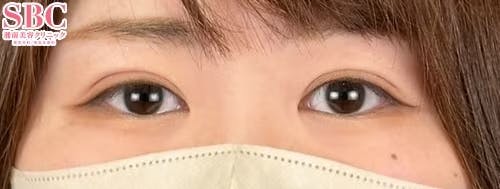 【20代女性・目元】クイックコスメティーク・ダブルNeo_after