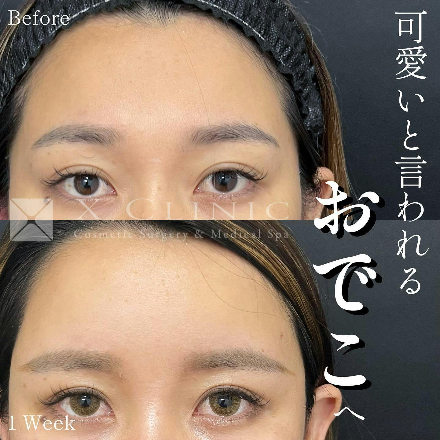 【20代女性・額】ベイビーおでこ＋エクソソーム_before_aftar