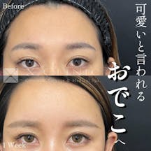【20代女性・額】ベイビーおでこ+エクソソーム_before_aftar