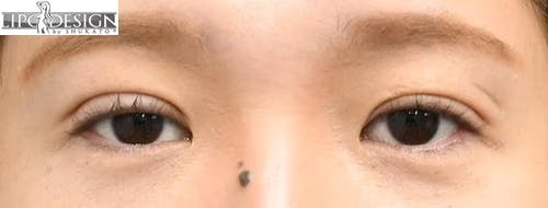 【33歳女性・目元】グランドループ法_1week