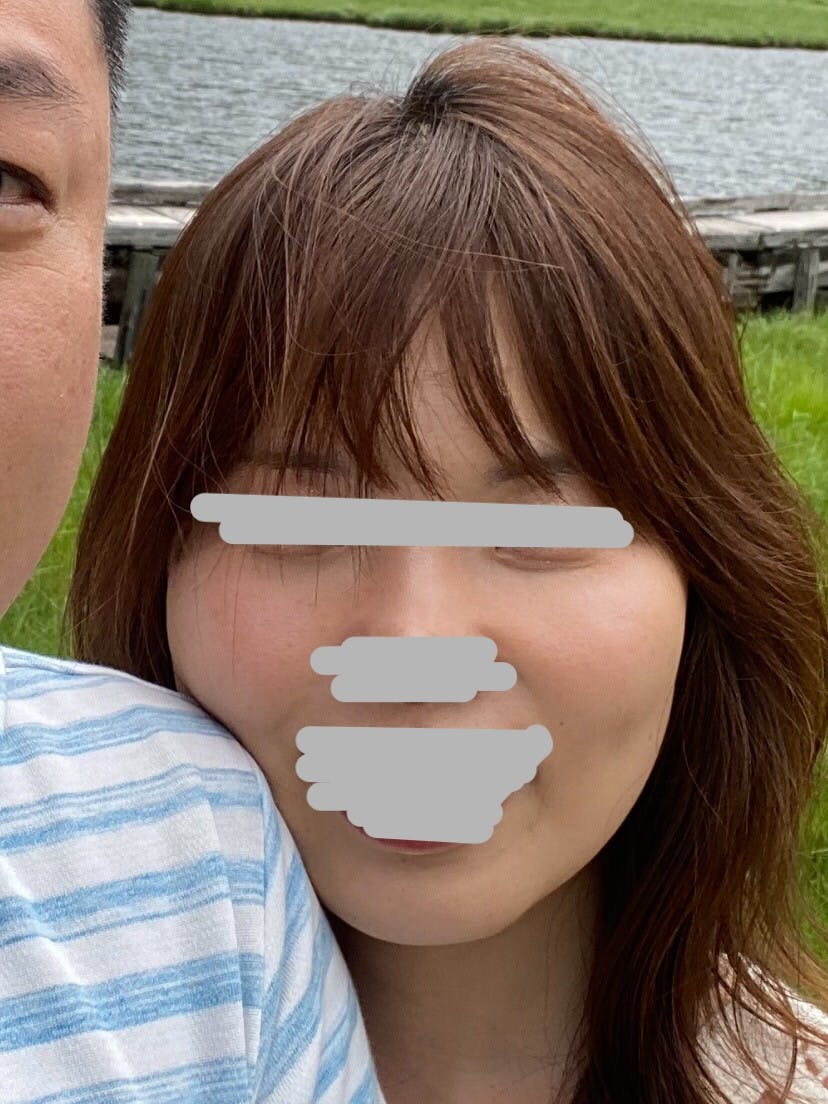 湘南美容クリニック 品川院でを受けた山藤さんの写真