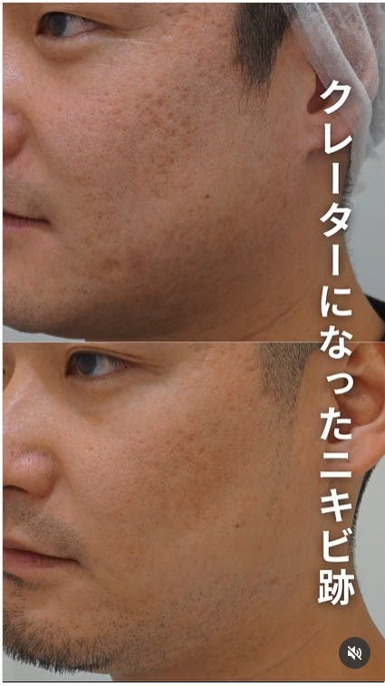 【男性・ニキビ跡】エルメスピール・ピコフラクショナル_before_aftar