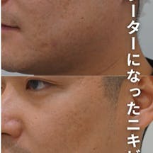 【男性・ニキビ跡】エルメスピール・ピコフラクショナル_before_aftar