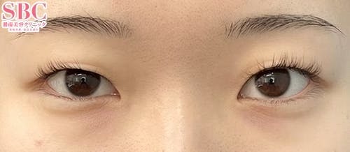 【女性・目元】クイックコスメティーク・ダブルNeo、目頭切開プレミアム、目尻切開法_before