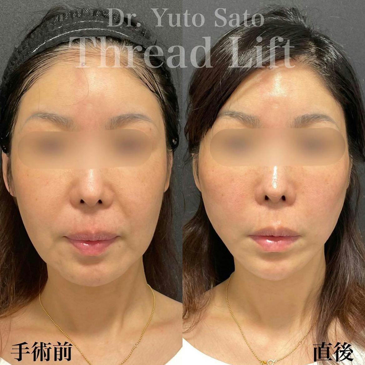 【女性・輪郭】糸リフト ヒアルロン酸 ボトックス_before_aftar