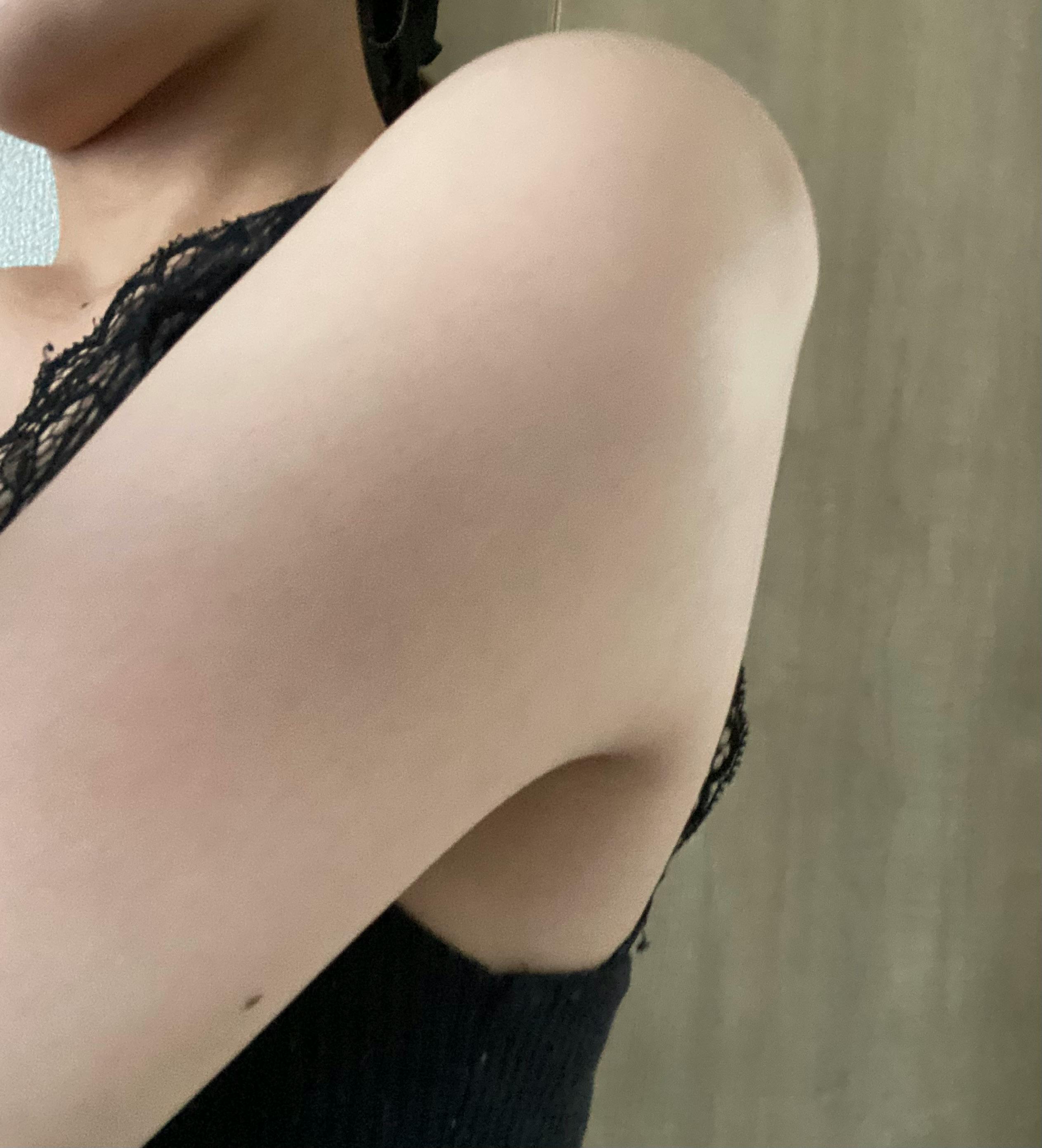 湘南美容クリニック 名古屋院で医療脱毛・胸の医療脱毛・お尻の医療脱毛・腹の医療脱毛・背中の医療脱毛・膝下の医療脱毛・肘下の医療脱毛・太もも・膝上の医療脱毛・肘上の医療脱毛を受けたあいさんの写真