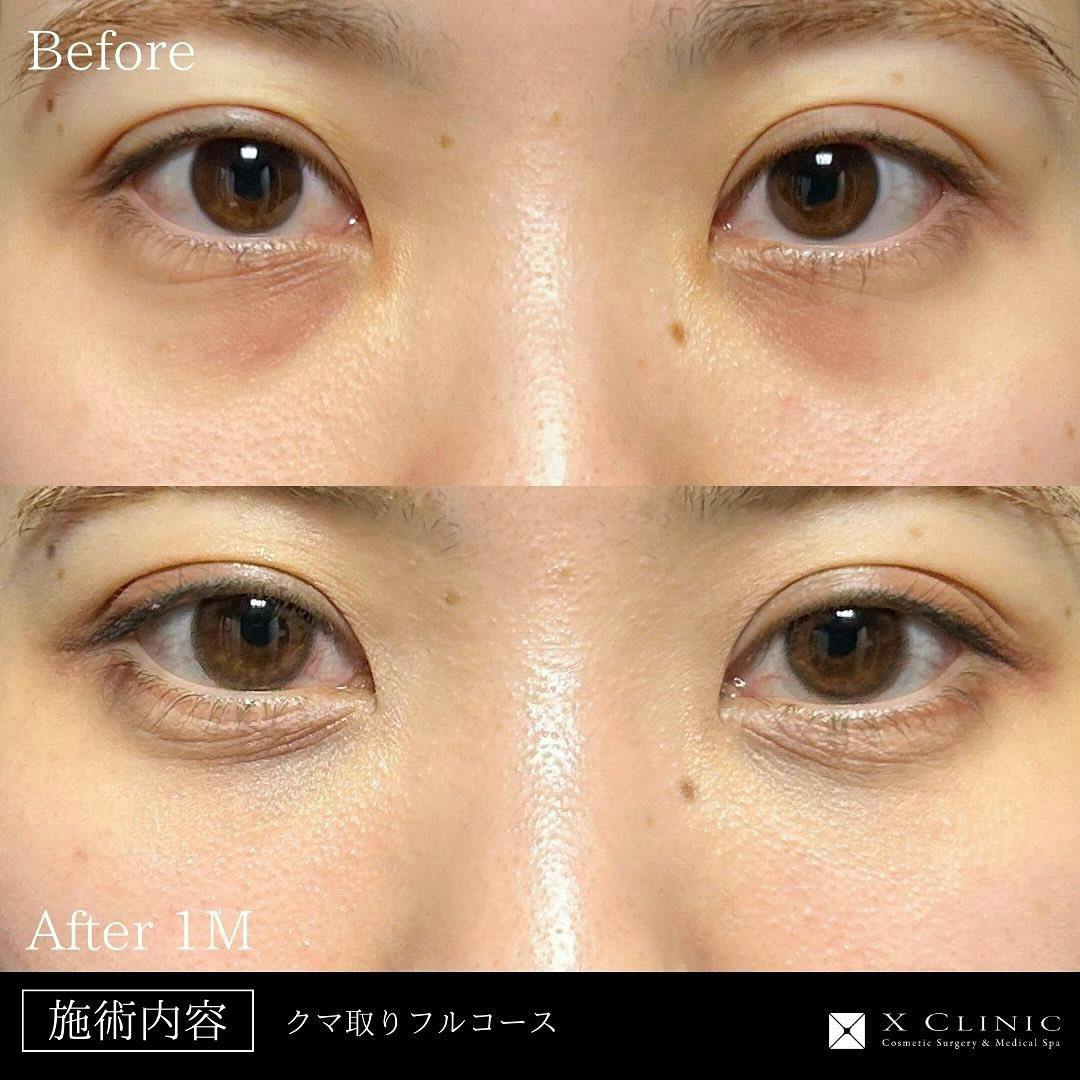 【20代女性・目元】クマ取りフルコース＋PRP_before_aftar