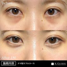 【20代女性・目元】クマ取りフルコース+PRP_before_aftar