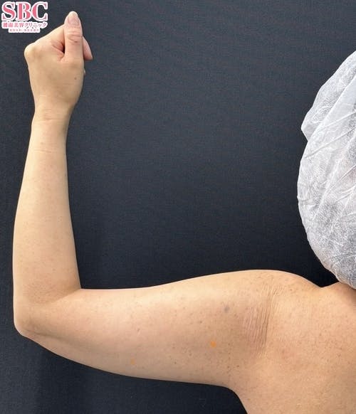 【女性・二の腕】美ボディ脂肪吸引_before