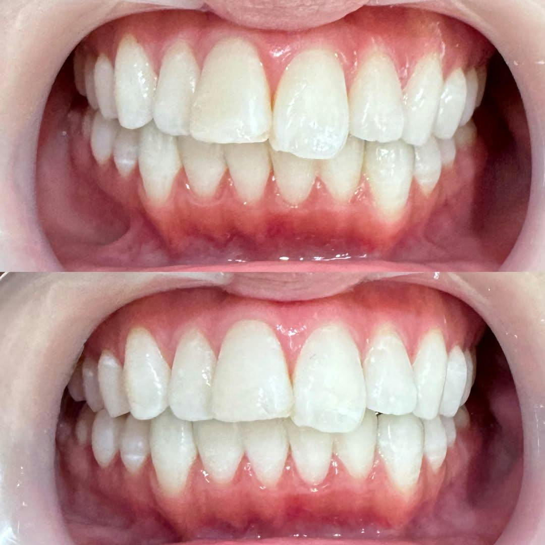 【歯】ホワイトニング_before_aftar