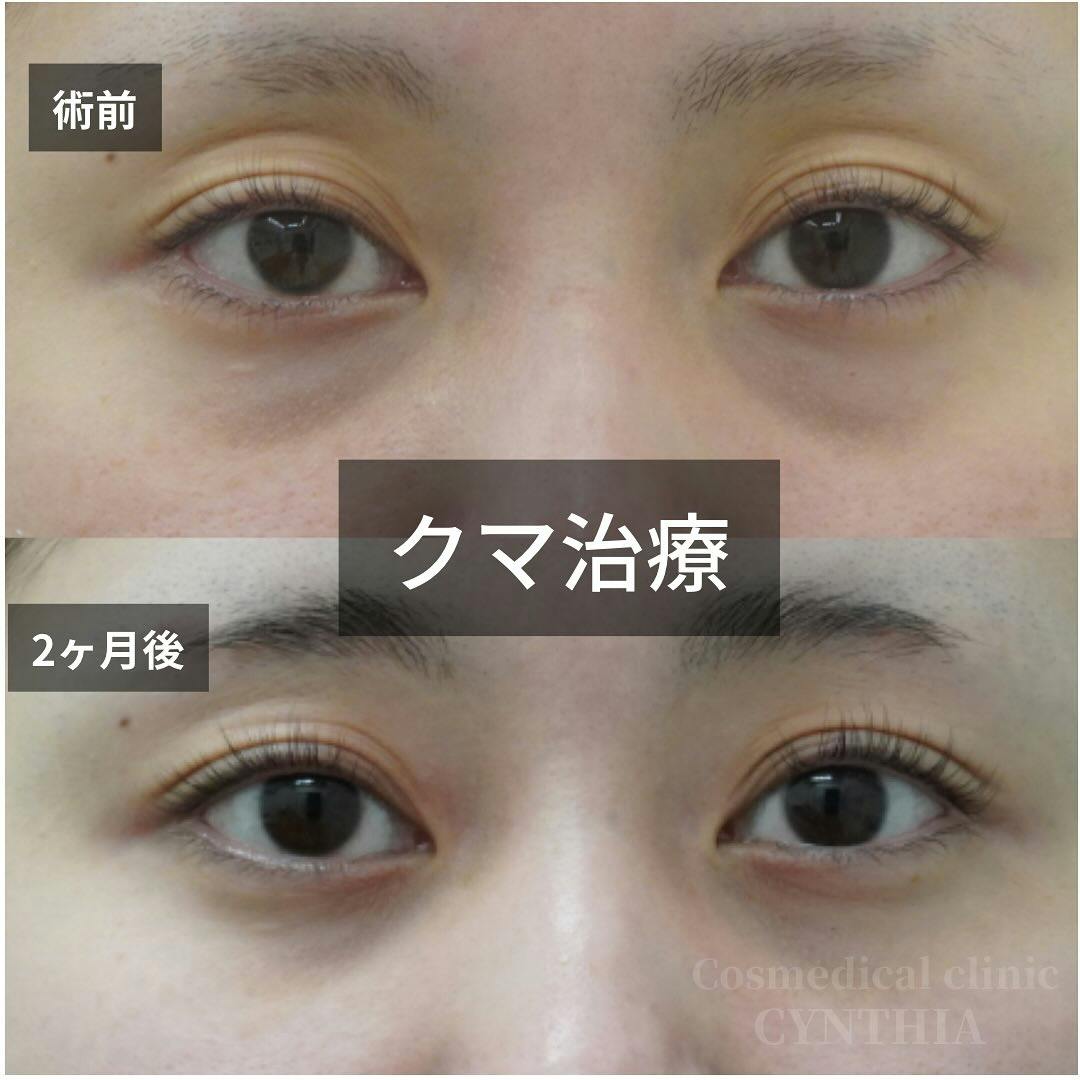 【30代女性・目元】目の下のクマ・たるみ取り_before_aftar