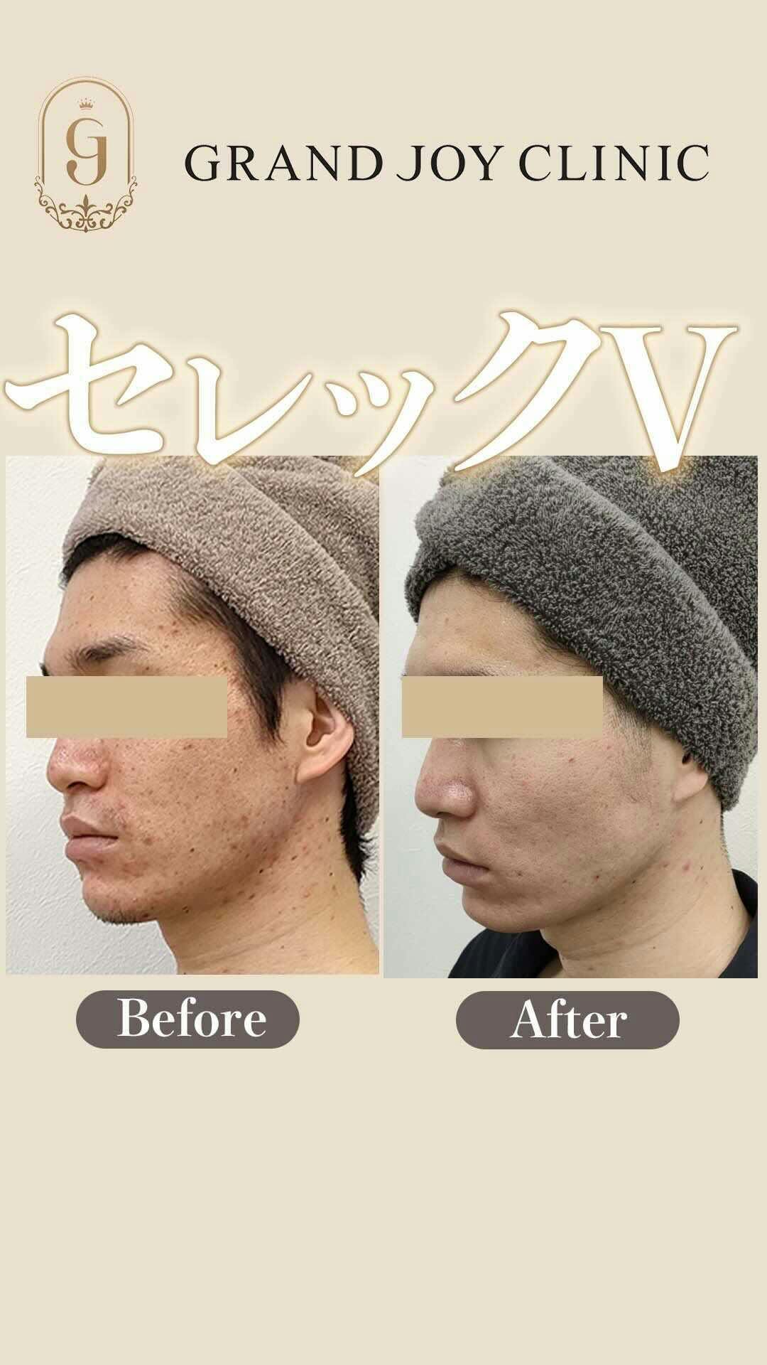 【男性・ニキビ】IPL光治療セレックV_before_aftar