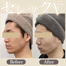 【男性・ニキビ】IPL光治療セレックV_before_aftar