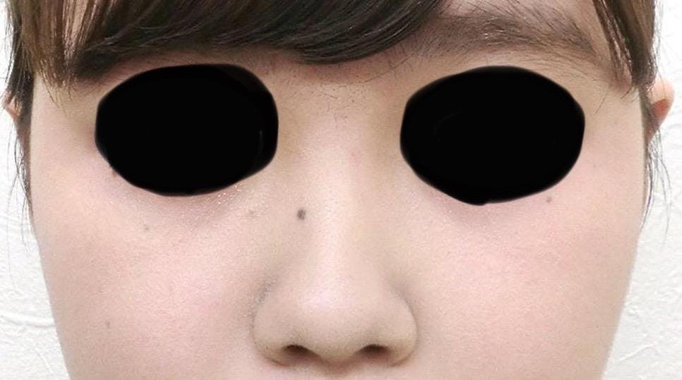 みずほクリニックで耳・耳たぶの整形：立ち耳整形（立ち耳にする整形術）を受けたさんさんの写真