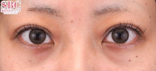 【20代女性・目元】クイックコスメティーク・トリプルNeo_1week