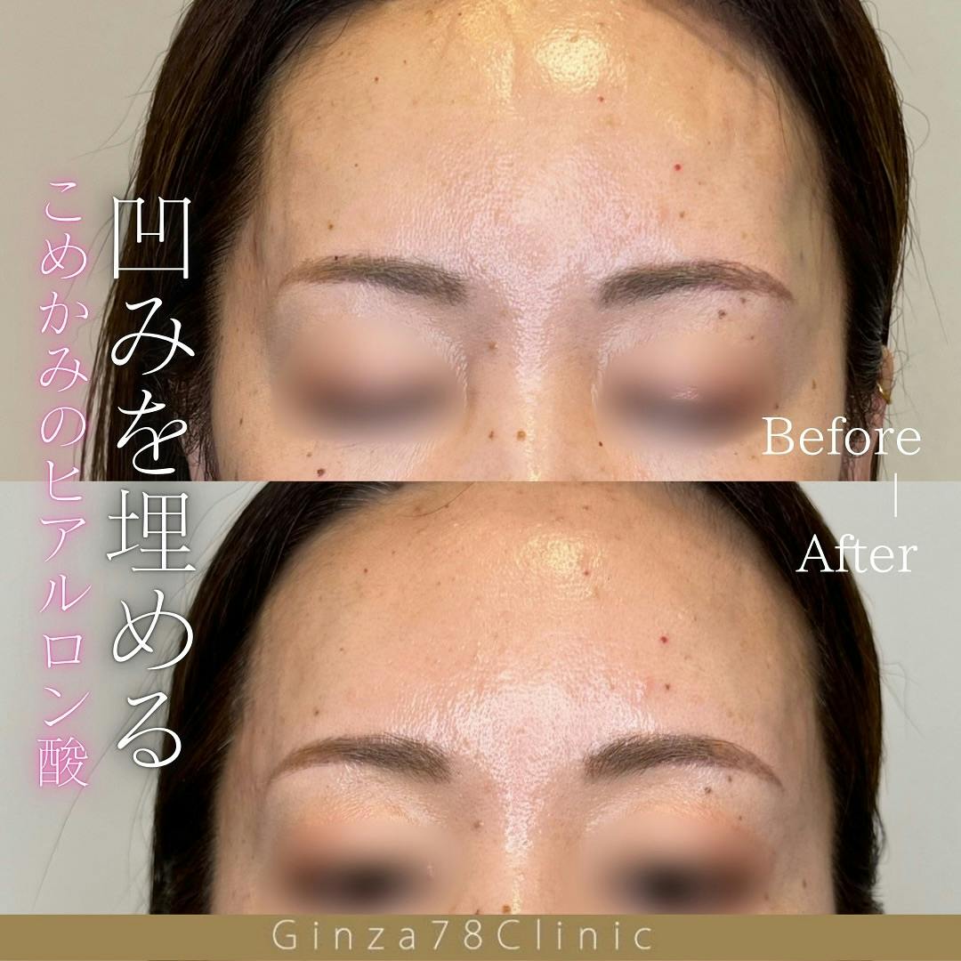 ヒアルロン酸注射・注入・ニューラミス・ジュビダーム(ヒアルロン酸