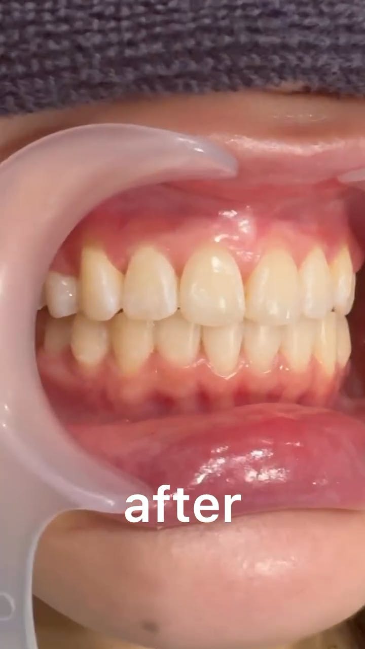 【歯】ホワイトニング_aftar