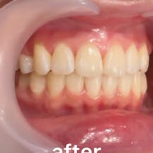 【歯】ホワイトニング_aftar