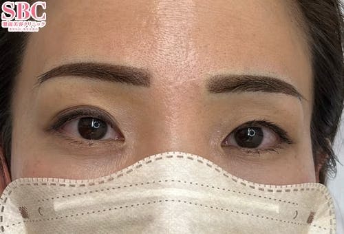 【女性・眉】医療アートメイク、アートメイク(眉毛)_after