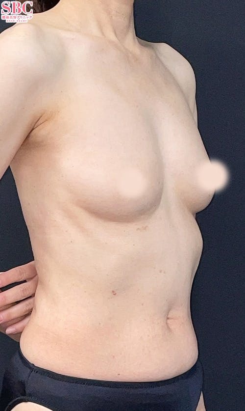 【女性・胸】コンデンスリッチ(脂肪注入豊胸)2回目・Aquicell（アキーセル）併用コンデンスリッチ(脂肪注入豊胸)_after