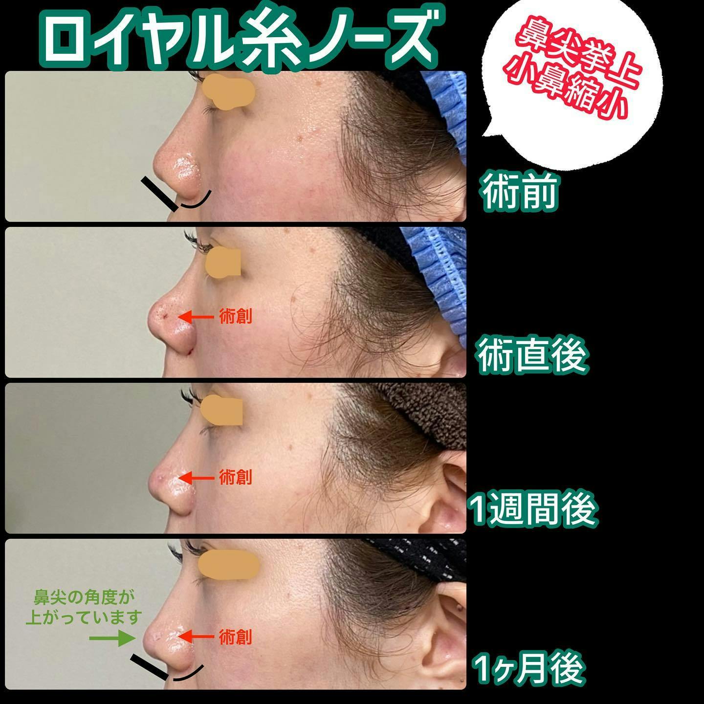 【女性・鼻】ロイヤル糸ノーズ_before_aftar