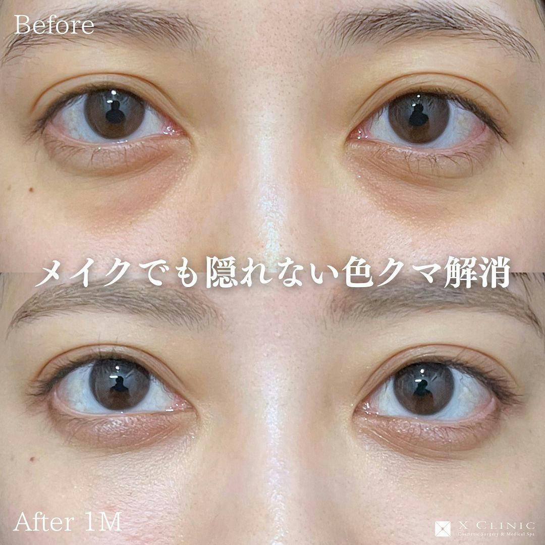 【20代女性・目元】クマ取りフルコース＋エクソソーム_before_aftar