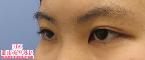 【女性・目元クイックコスメティーク・ダブルNeo・クイックコスメティーク・シングルNeo・目頭切開プレミアム_before