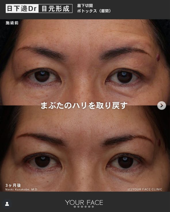 【女性・目元】眉下切開術_before_aftar