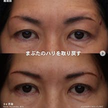 【女性・目元】眉下切開術_before_aftar
