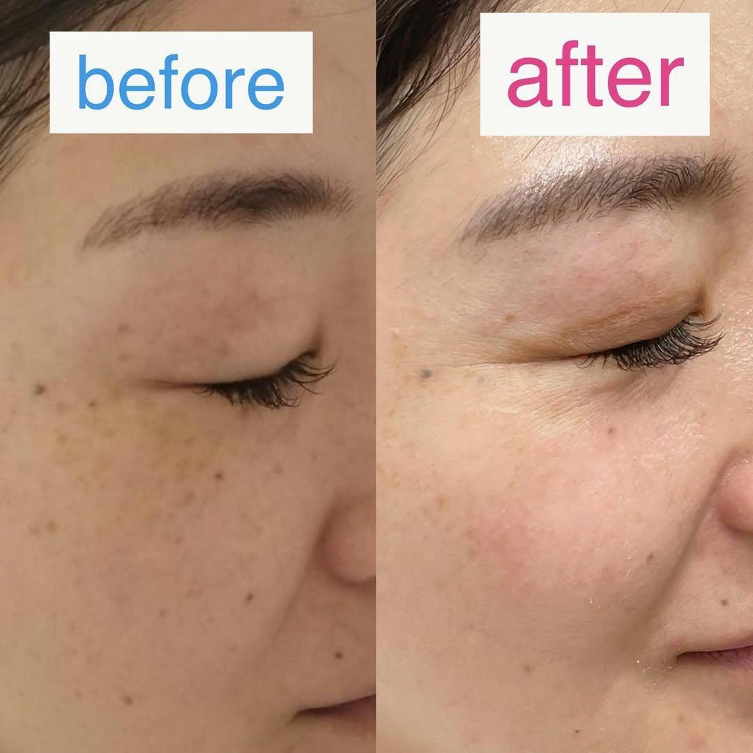 【女性・シミ】IPLフォトフェイシャル_before_aftar