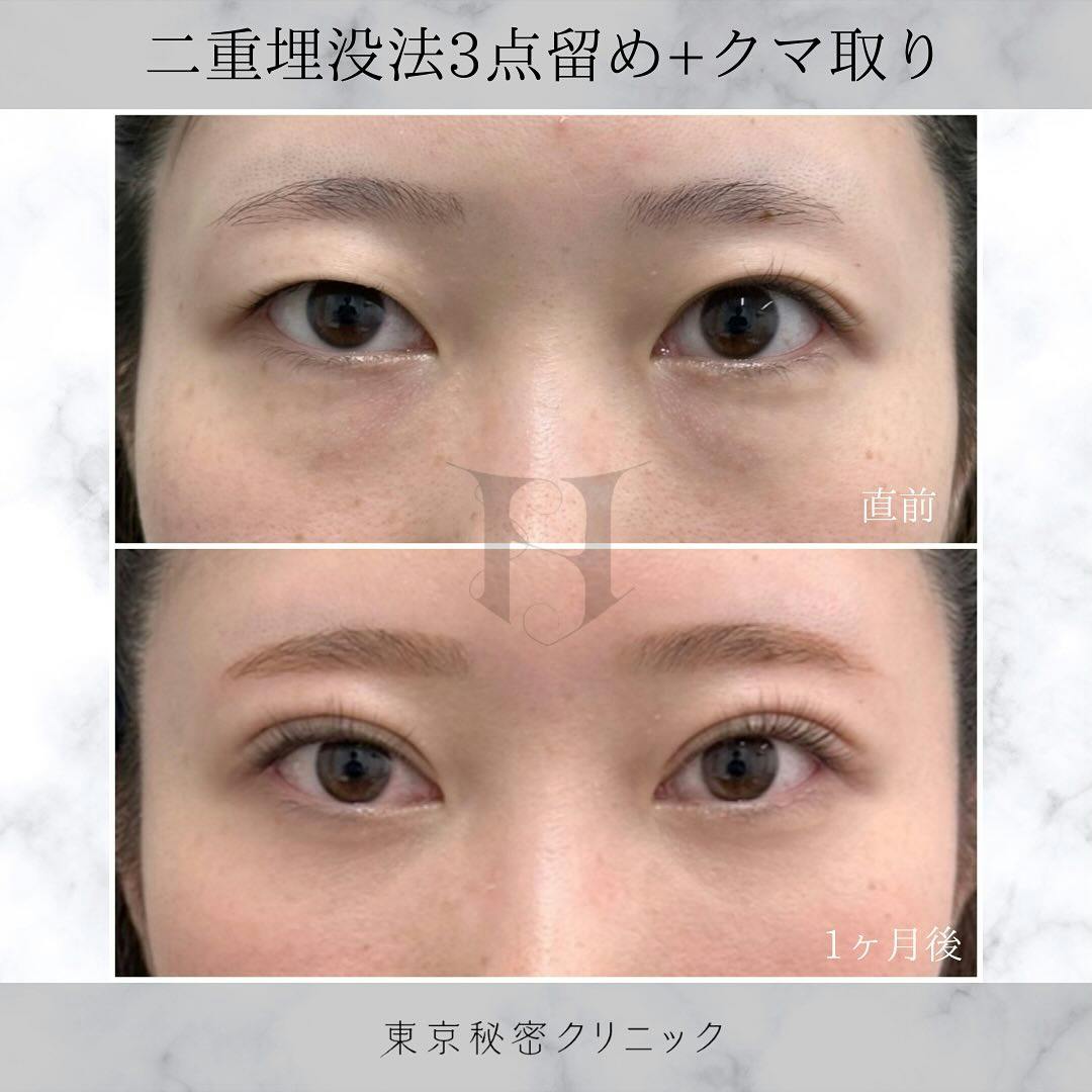 【女性・目元】二重埋没_before_aftar