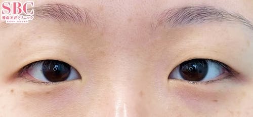 【30代女性・目元】クイックコスメティーク・トリプルNeo、目頭切開プレミアム_before