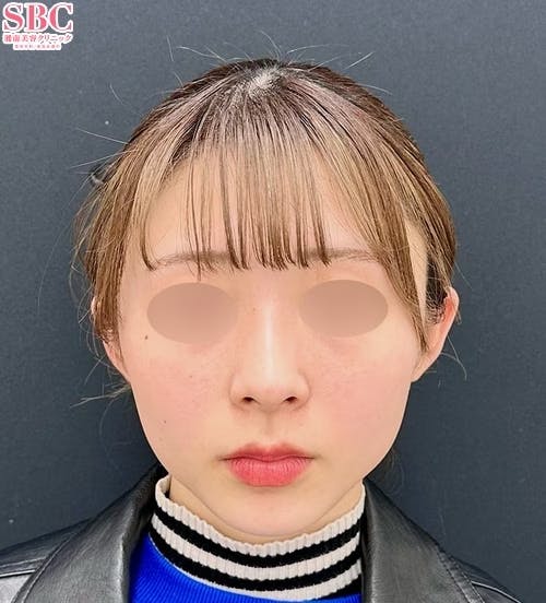 【20代女性・顔・頬】小顔用脂肪吸引注射_before