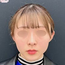 【20代女性・顔・頬】小顔用脂肪吸引注射_before