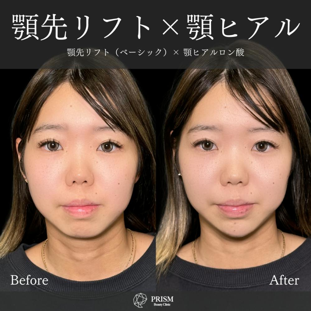 【20代女性・顎】あご先リフト＋ ヒアルロン酸（顎）_before_aftar
